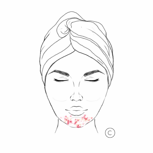 Why Hormonal Acne Needs a Whole-Body Approach — And Why Support Matters More Than You Think