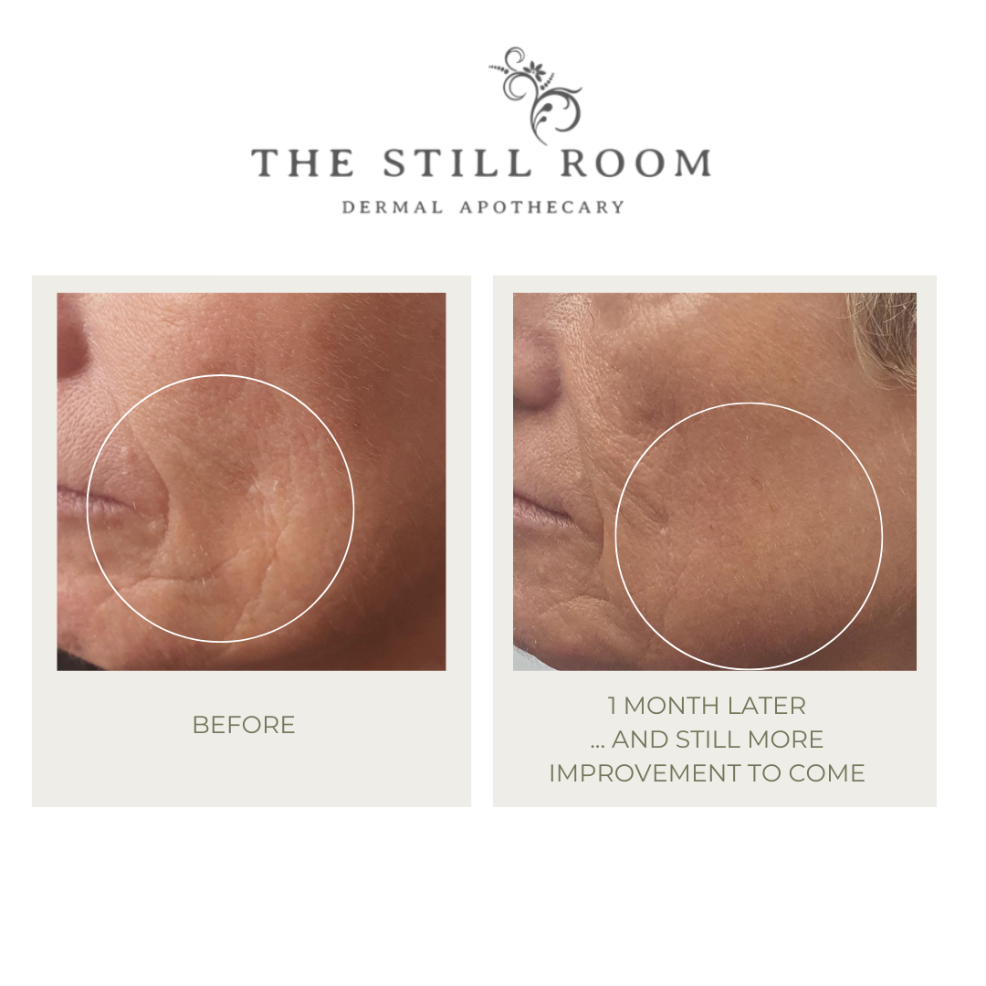 Are There Natural Alternatives to Botox?